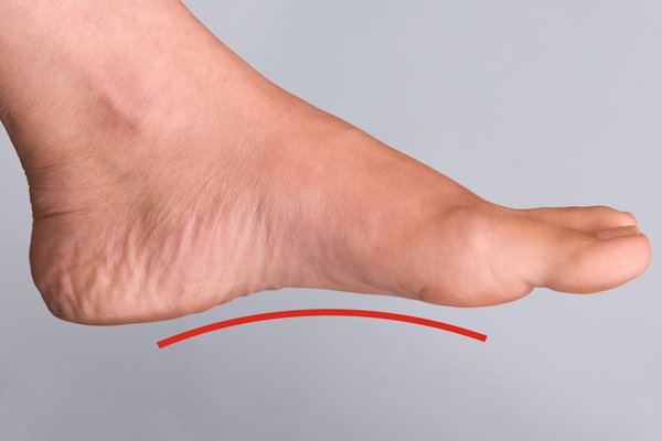 Ilustración de pie plano comparado con arco plantar normal — calzado barefoot como solución